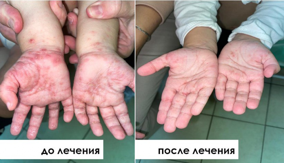 Врачи Педиатрического университета рассказали, к каким осложнениям может привести чесотка