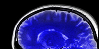 Заболевания мозга могут возникать от бытовой химии — ученые