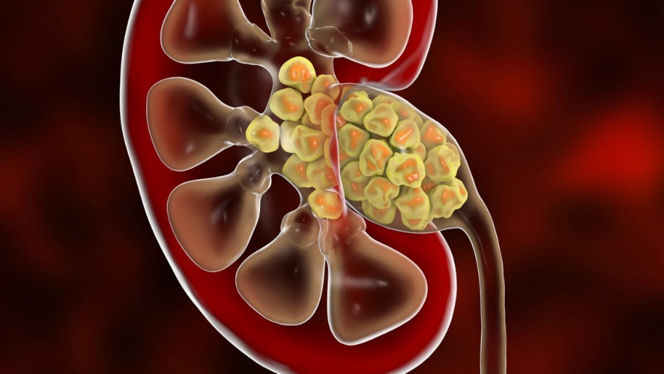Внутри камней в почках обнаружили бактерии - ученые пересматривают причины их появления