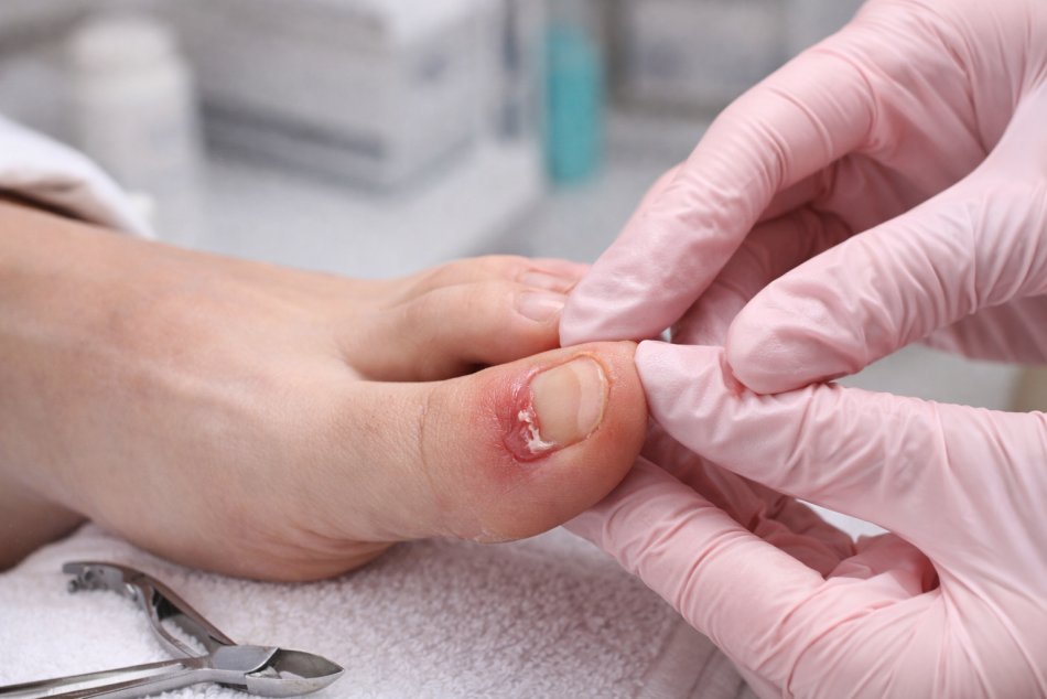 Вросший ноготь: почему возникает и как лечат сегодня